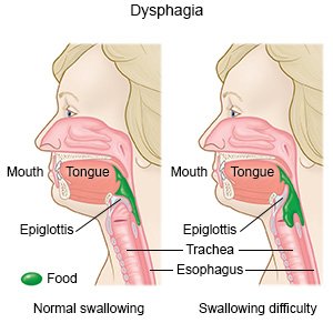 Dysphagia