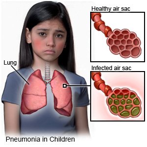 Pneumonia in Children