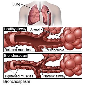 Bronchospasm