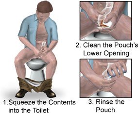 Ileostomy Creation Aftercare Instructions What You Need To Know Picture Of Emptying Cleaning And Rinsing An Ostomy Bag