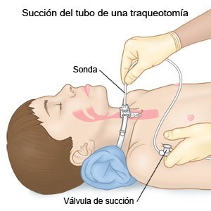 Aspiración de un tubo de traqueostomía