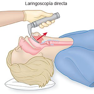 Laringoscopía directa