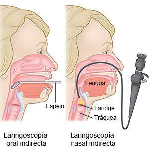 Laringoscopia indirecta oral y laringoscopía indirecta nasal