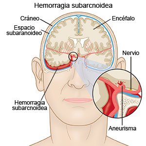 Hemorragia subaracnoidea