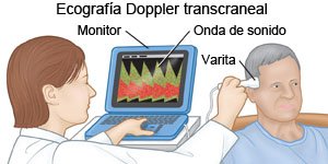 Ecografía Doppler transcraneal