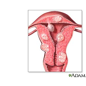 recuperacion de una operacion de miomas recuperacion de una operacion de miomas
