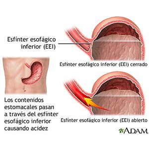 Esofagitis y perdida de peso repentina