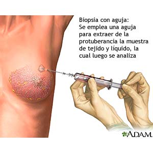 La ropa blanca correccional después del aumento del pecho