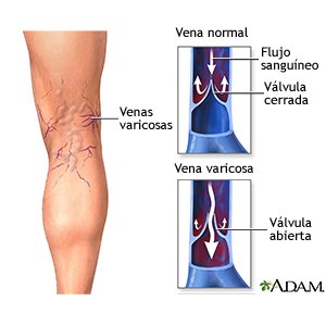 de la perna varicoasa ce produse trebuie utilizate în varicoza