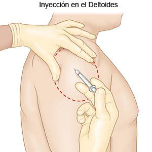 Inyección en deltoides