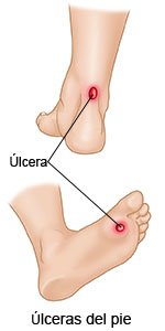 Úlceras del pie