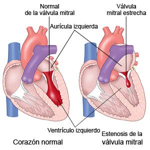 Válvula mitral normal Válvula mitral estrecha