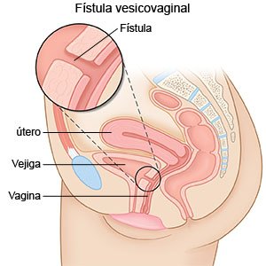 Fístula vesicovaginal