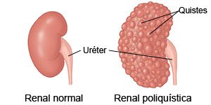 Riñón normal Riñón poliquístico