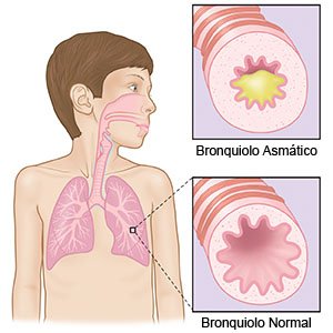 Bronquiolos normales vs bronquiolos con asma