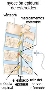 Inyección epidural de esteroides