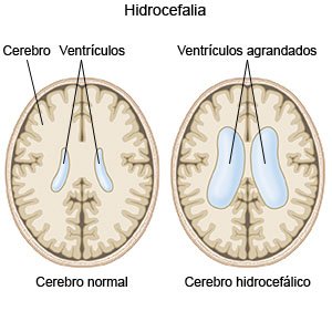 Hidrocefalia