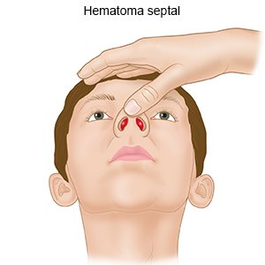 Hematoma septal