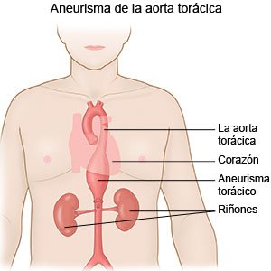 Aneurisma de la aorta torácica