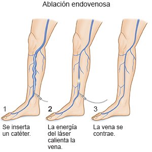 Ablación endovenosa