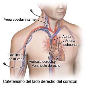 Cateterismo del lado derecho del corazón