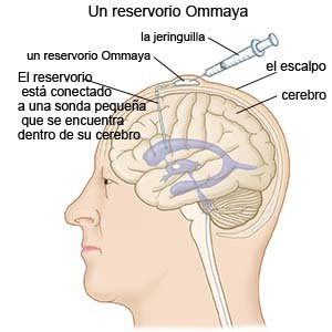 Depósito de Ommaya