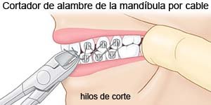 Cortadores de alambre para mandíbula