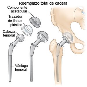 Reemplazo total de cadera