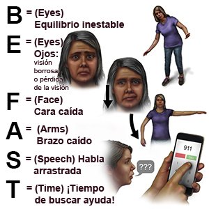 SIGNOS DE LA PRUEBA E.O. C.B.H.T. PARA RECONOCER UN DERRAME CEREBRAL