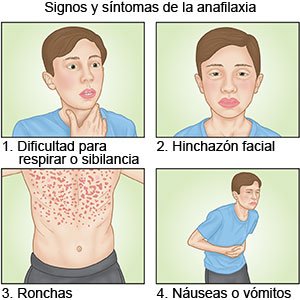 Signos y síntomas de la anafilaxia