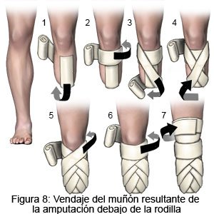 Vendaje del muñón resultante de la amputación debajo de la rodilla