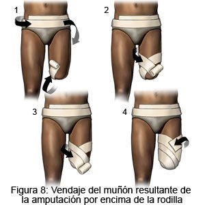 Vendaje del muñón resultante de la amputación por encima de la rodilla