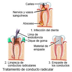 pandilla artículo empujoncito Tratamiento De Conducto Radicular Care Guide Information En Espanol