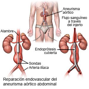 Reparación de aneurisma aórtico abdominal