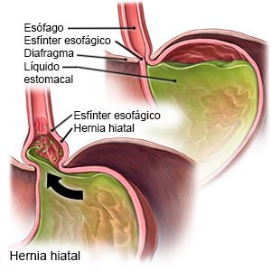 Hernia hiatal