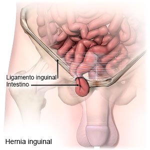 Hernia inguinal