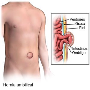 Hernia Umbilical Care Guide Information En Espanol