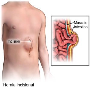 Hernia incisional