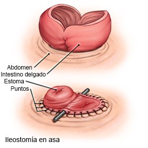 Ileostomía en asa