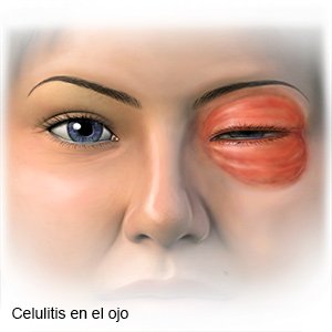 Celulitis en el ojo