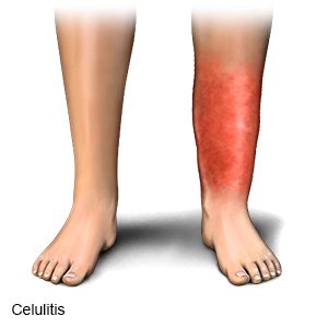 Celulitis