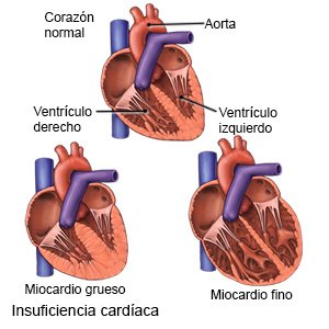 Insuficiencia cardíaca