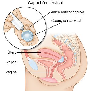 Capuchón cervical
