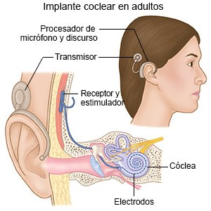 Implante coclear en adultos