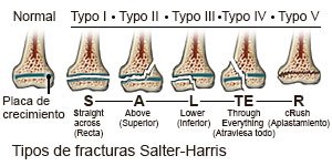 Fracturas Salter-Harris