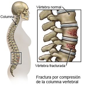 Fractura por compresión de la columna vertebral