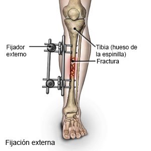 Dispositivo de fijación externa