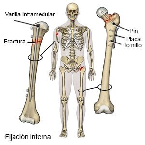 Dispositivo de fijación interna