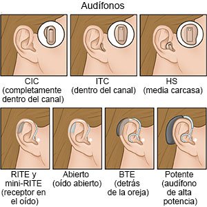 Tipos de audífonos