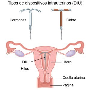 Los dispositivos intrauterinos (DIU)